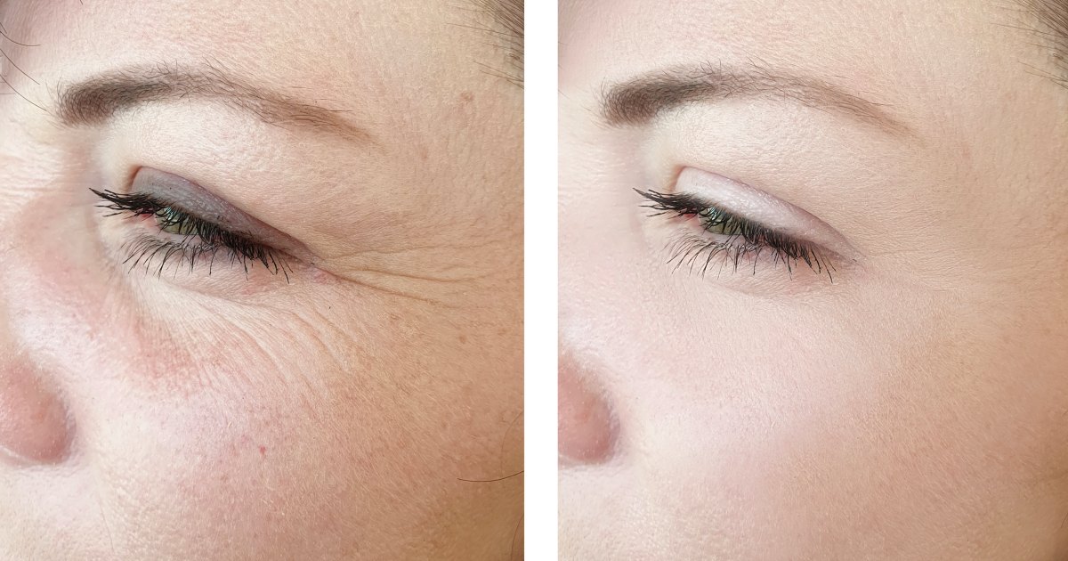 رتینول برای کاهش چین و چروک پوست