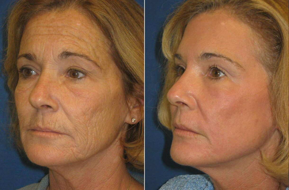 لیزر برای جوانسازی پوست