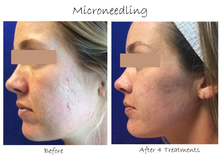 میکرونیدلینگ برای جوانسازی پوست