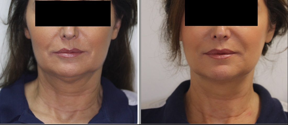 هایفو برای لیفت پوست