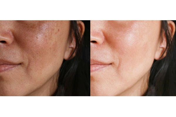 فواید ویتامین سی برای پوست